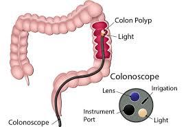 Sigmoidoscopy 