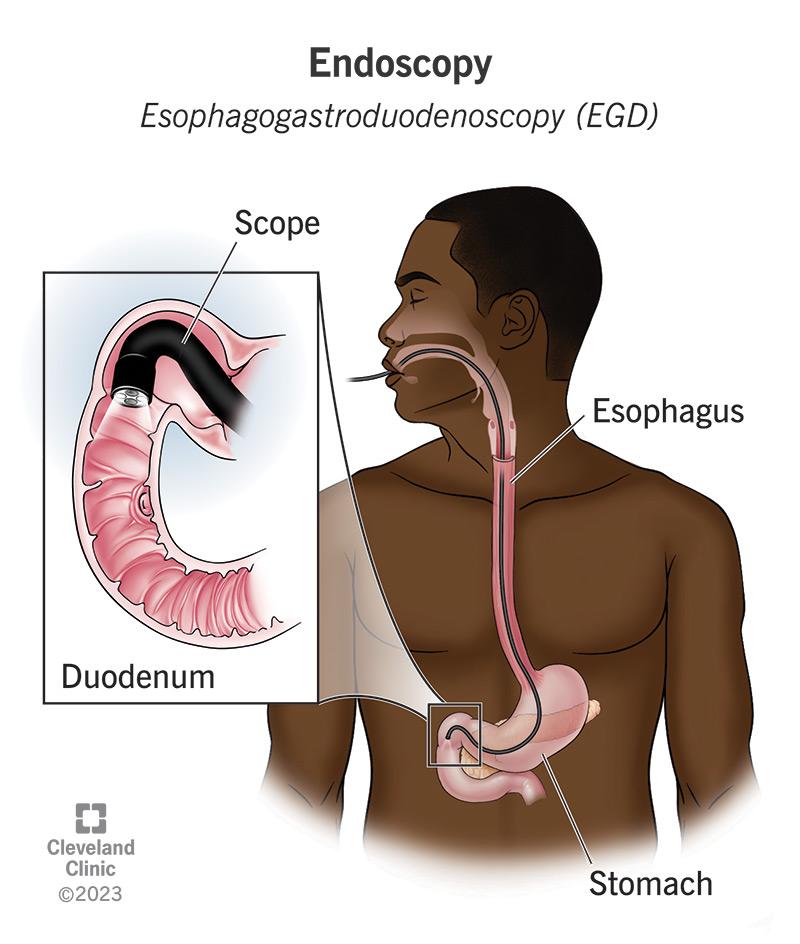 Endoscopy 